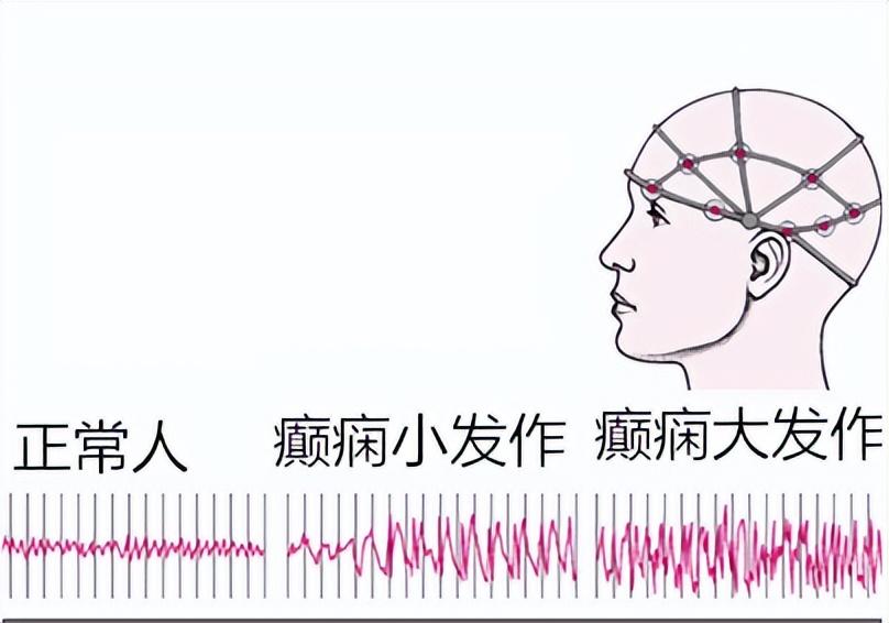 癇病最新治療方法概述，癇病最新治療方法概述與進展